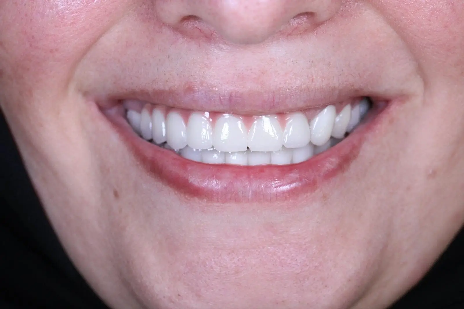 İmplant Tedavisi Sonrası