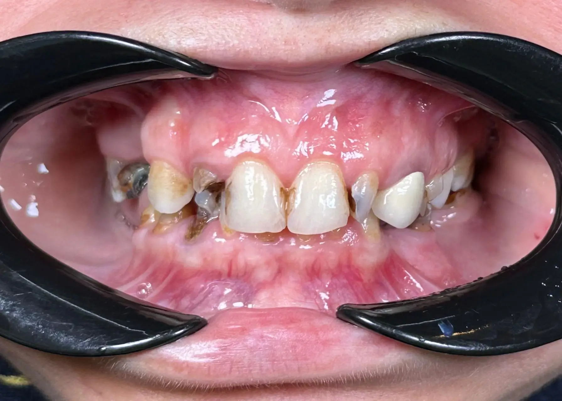 İmplant Tedavisi Öncesi