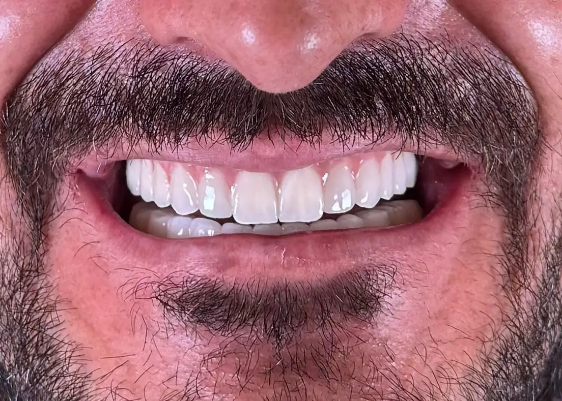 İmplant Tedavisi Sonrası