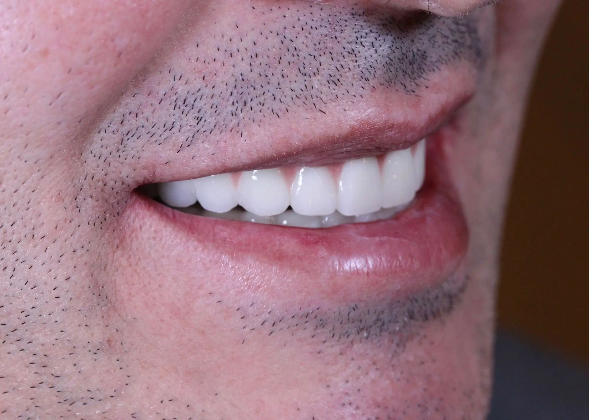 İmplant Uygulaması Sonrası