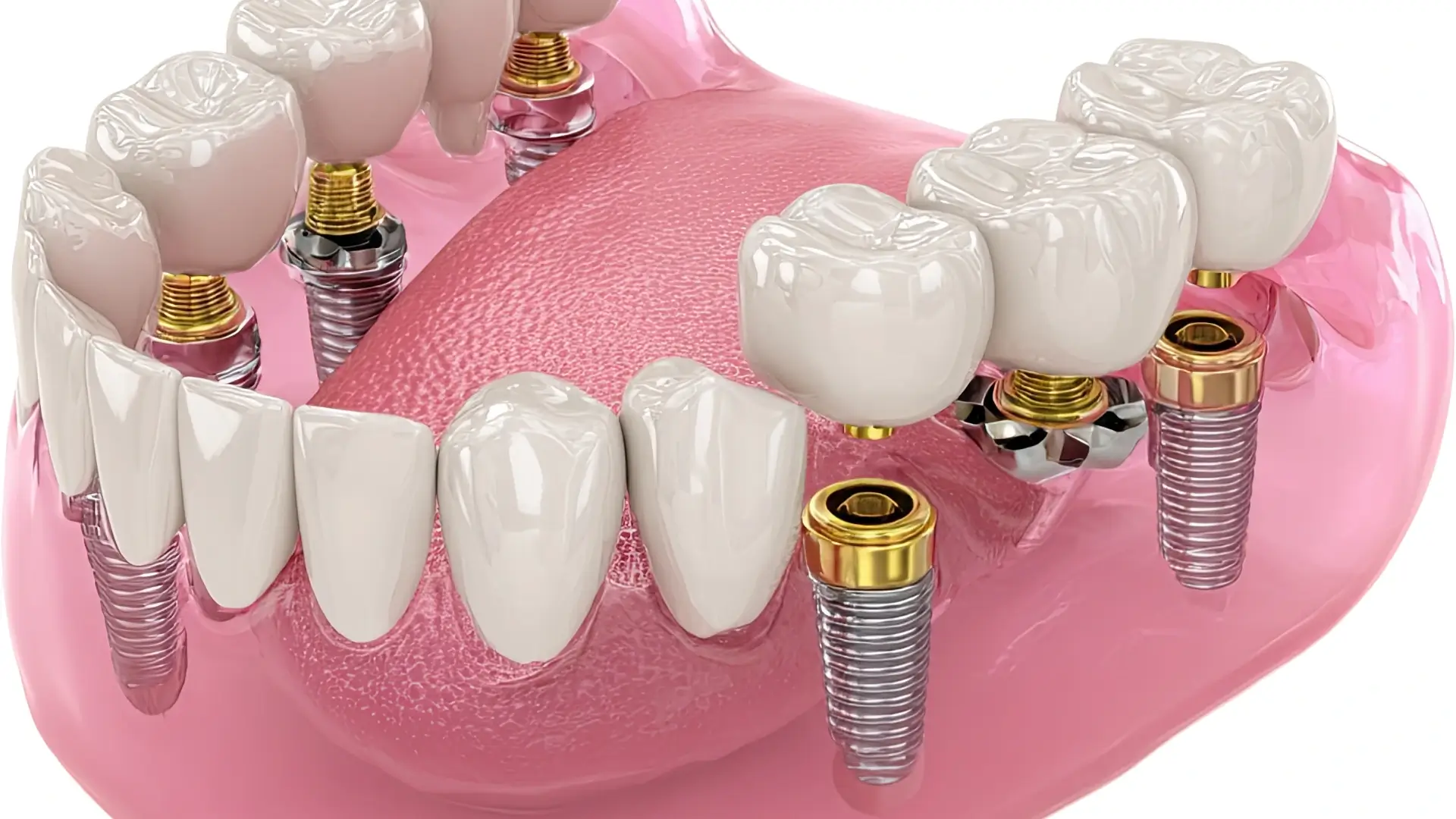 İmplant Kaç Yaşında Yapılmalıdır? Yaş Sınırı Nedir?