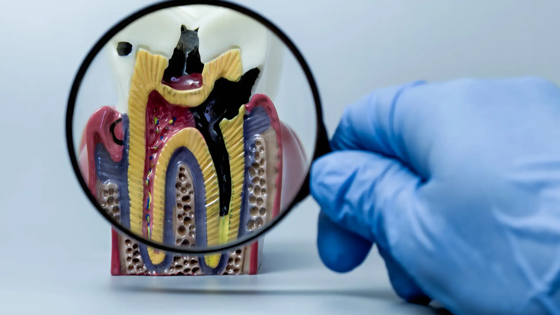 Ön Diş Kanal Tedavisi Nasıl Yapılır? Ne Kadar Sürer?