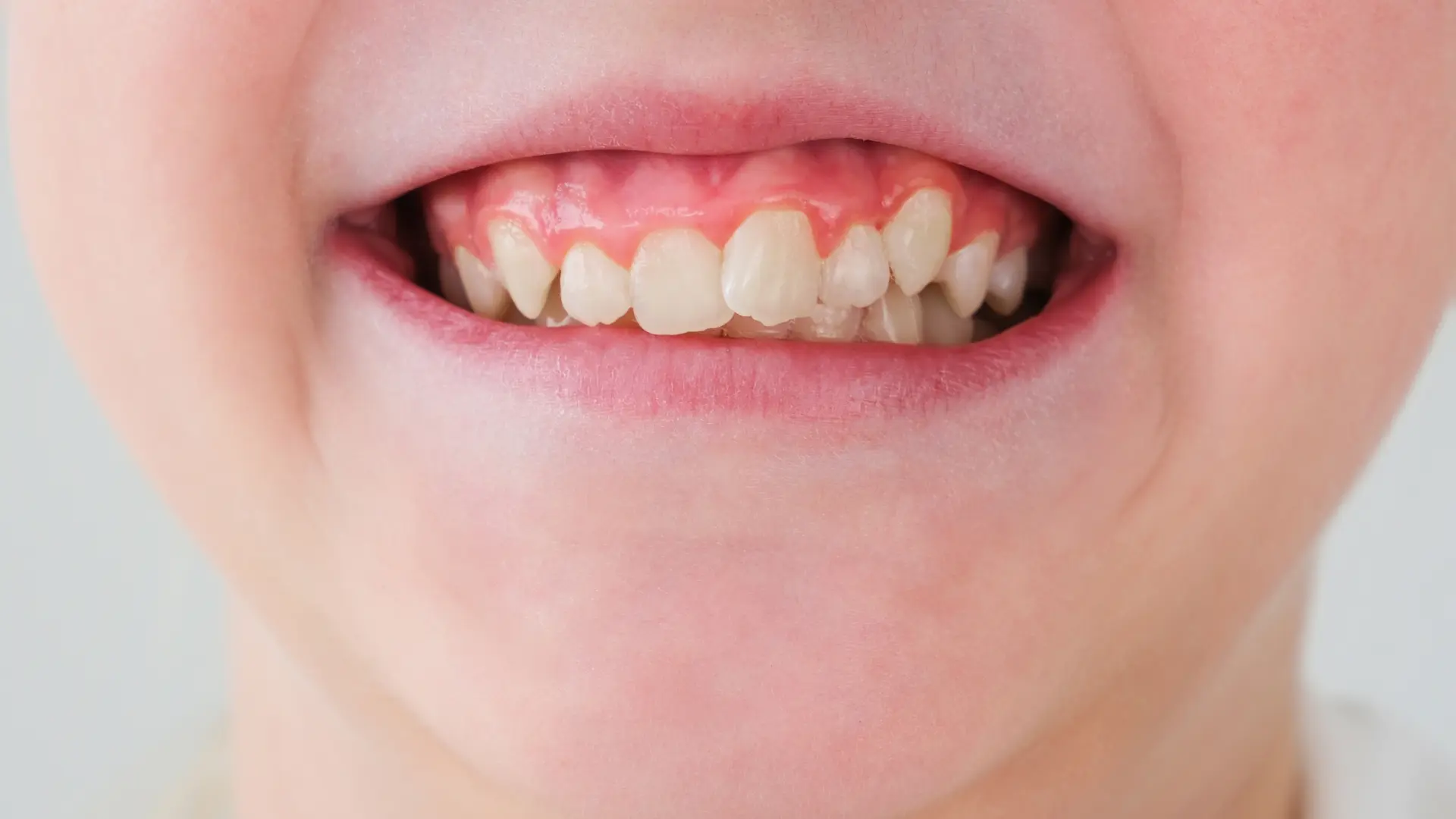 Çarpık, Yamuk Dişler Nasıl Düzelir?