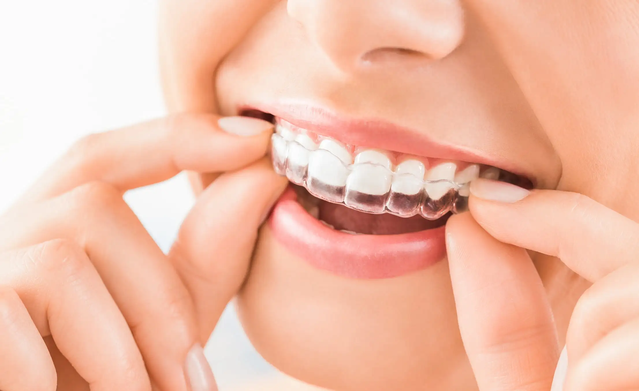 Invisalign (Şeffaf Plak) Tedavisi Nedir?